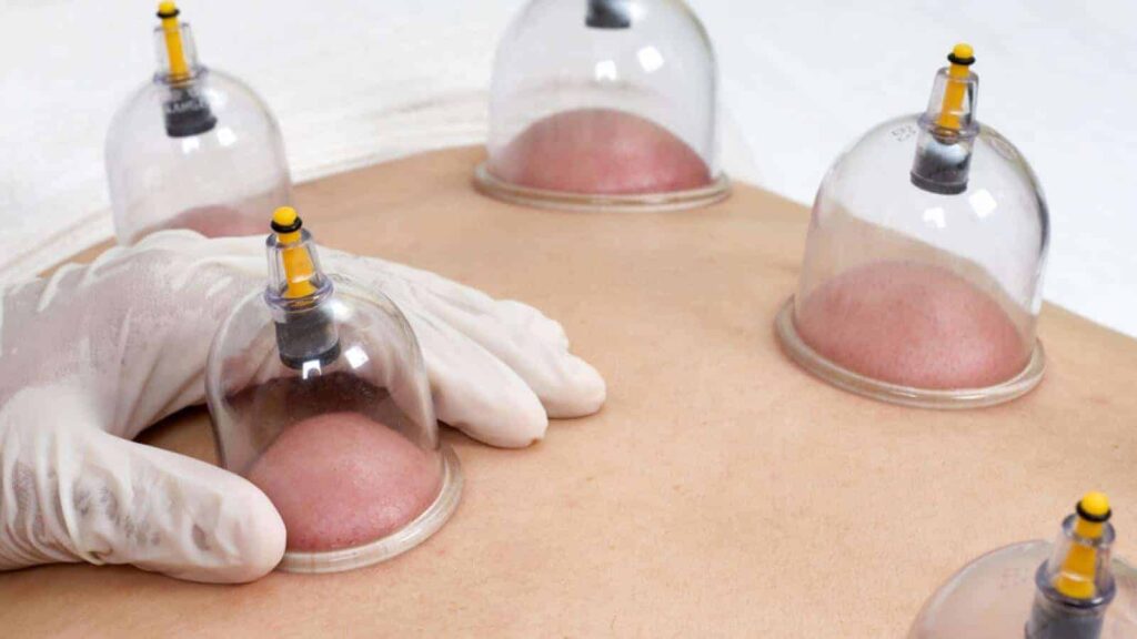 Alles over Hijama / Cupping